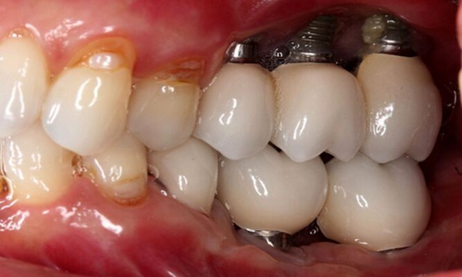 trồng răng implant giá rẻ chất lượng không đảm bảo
