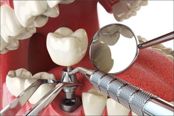 trồng răng implant giá rẻ chất lượng không đảm bảo