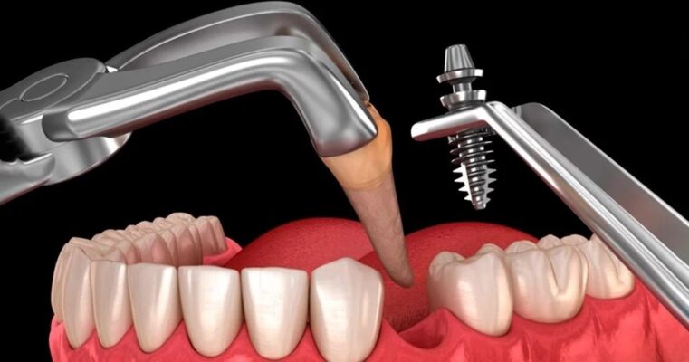 trồng răng Implant tức thì là gì