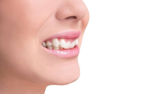 Răng khểnh bọc sứ được không