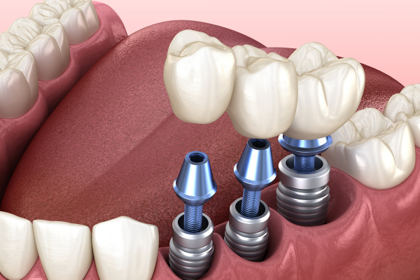 trồng răng implant giá rẻ