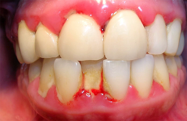 trồng răng Implant sai cách gây dị ứng
