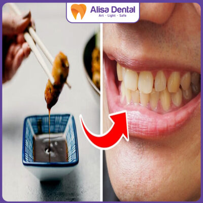 quy trình tẩy trắng răng