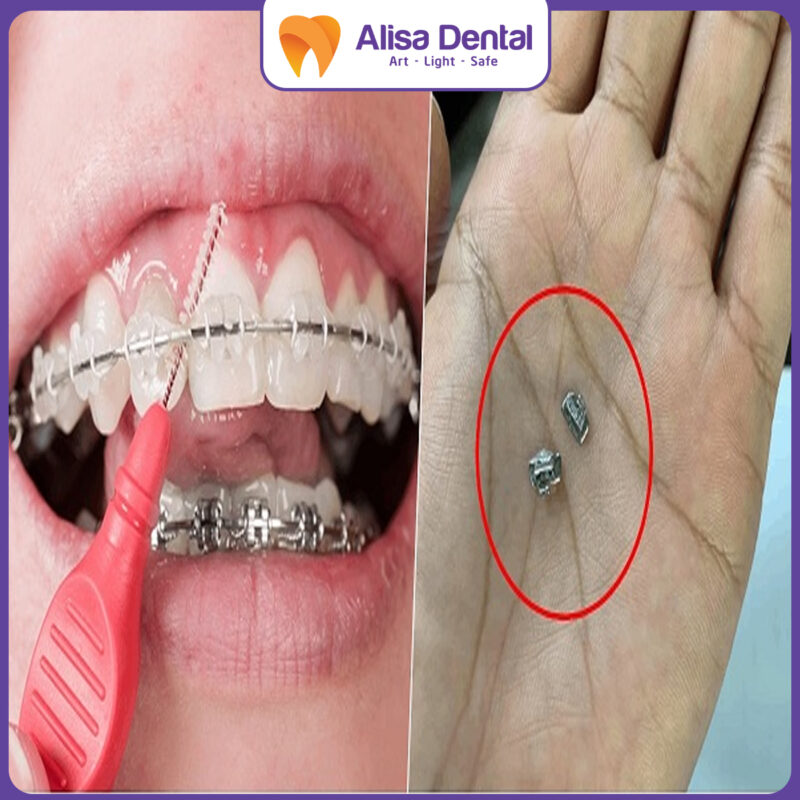 nuốt mắc cài