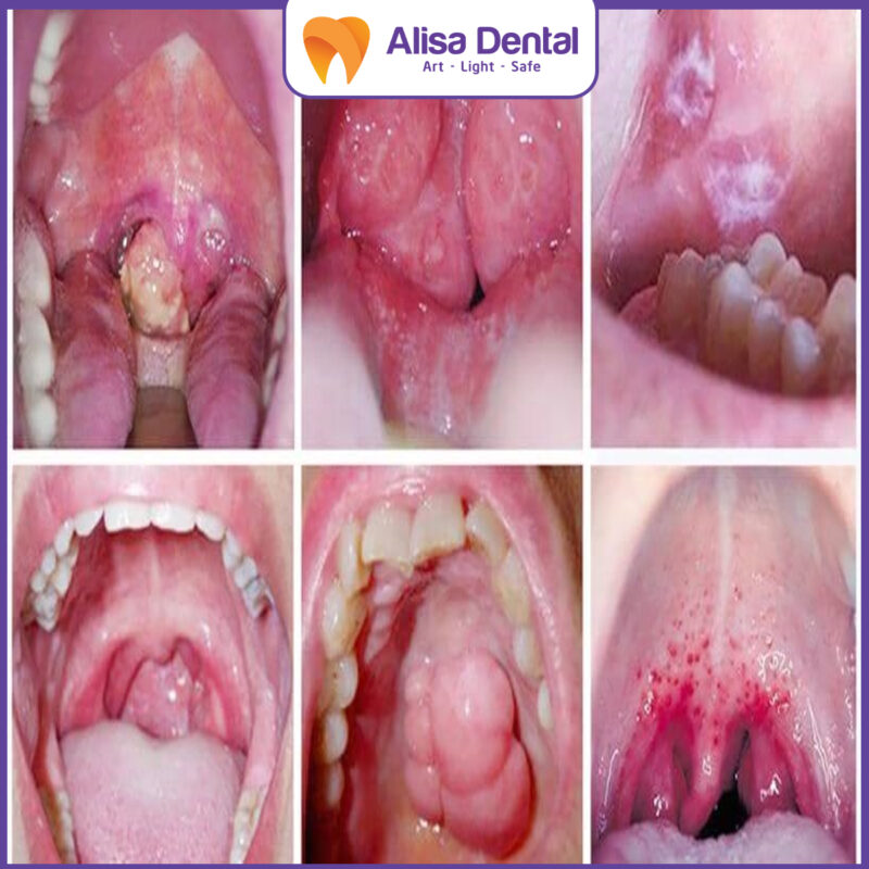 bệnh lý về răng ung thư miệng