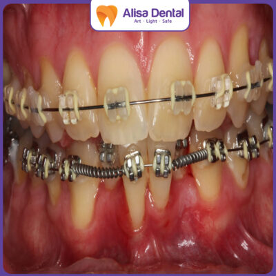 bật chân răng khi niềng răng