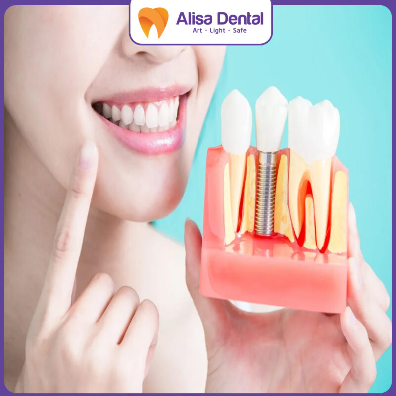trồng răng implant
