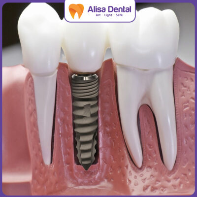 trồng răng implant