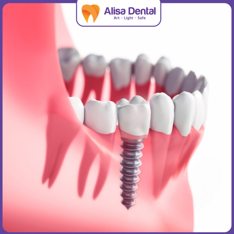 trồng răng implant