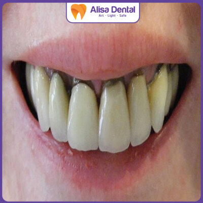 đen nướu khi bọc răng sứ