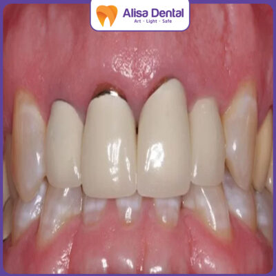 bọc răng sứ bị hở chân