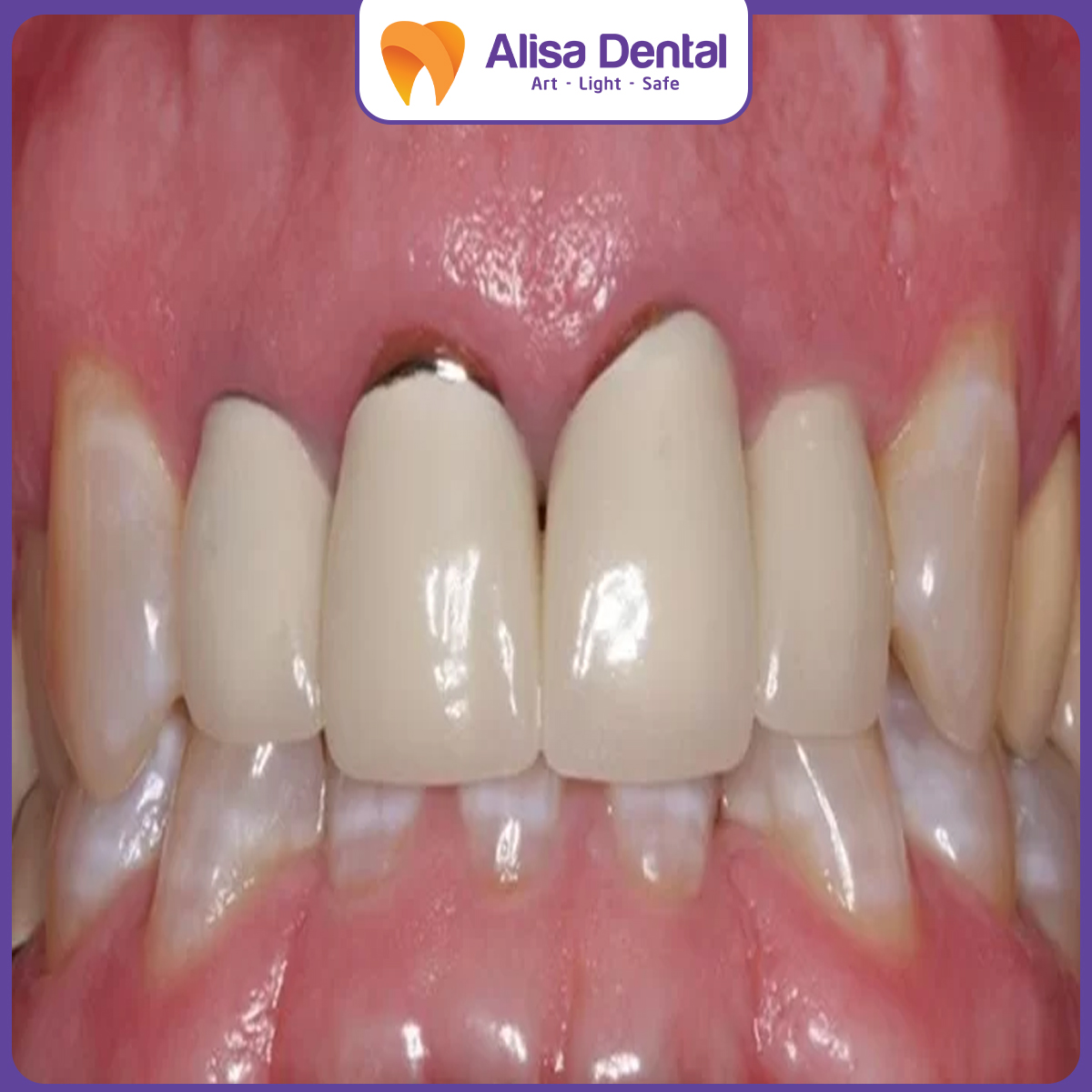 bọc răng sứ bị hở chân