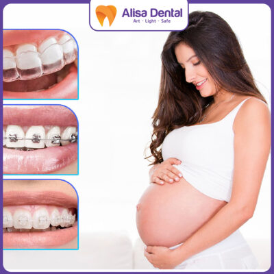 Mang bầu niềng răng