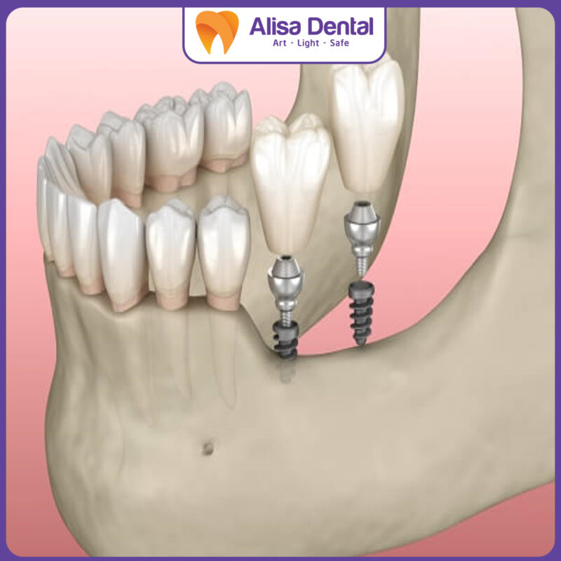 trồng răng Implant mini
