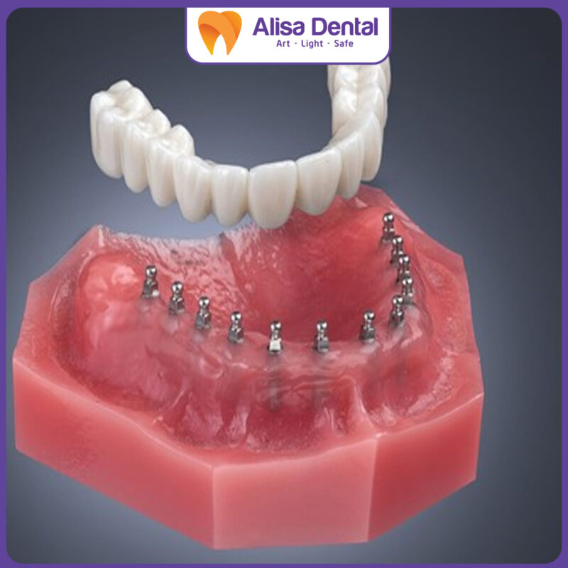 trồng răng Implant mini