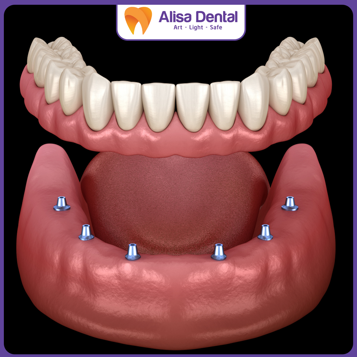 trồng răng Implant mini