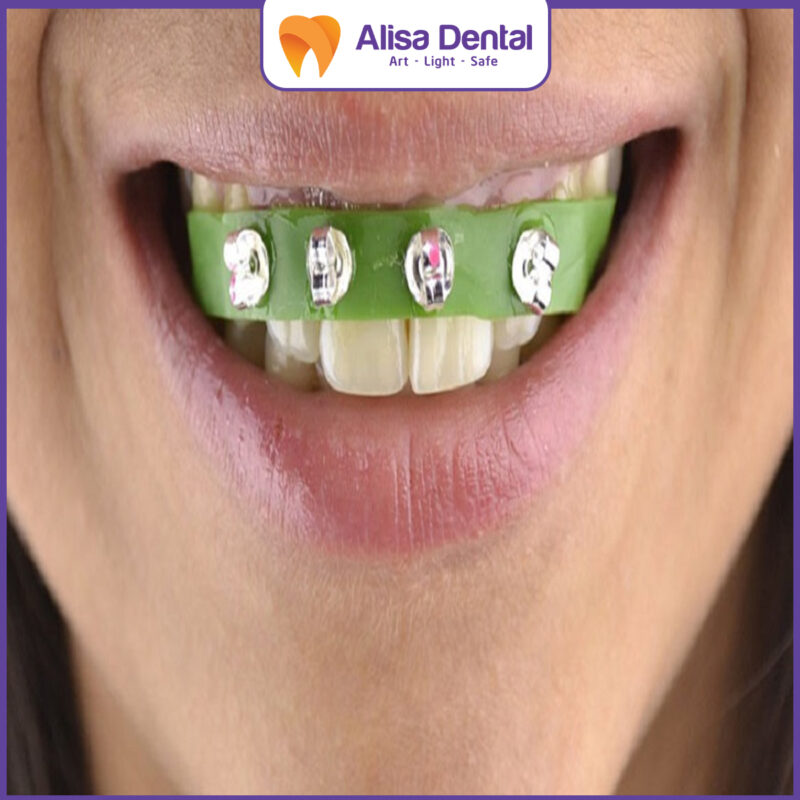niềng răng giá rẻ tại nhà