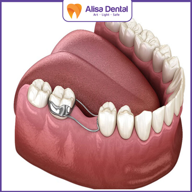 niềng răng giá rẻ tại nhà