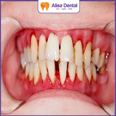 bệnh lý về răng viêm nha chu