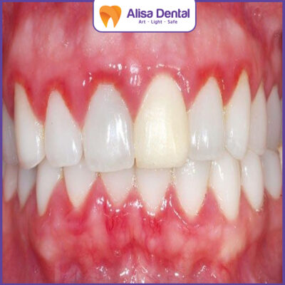 bệnh lý về răng viêm nướu