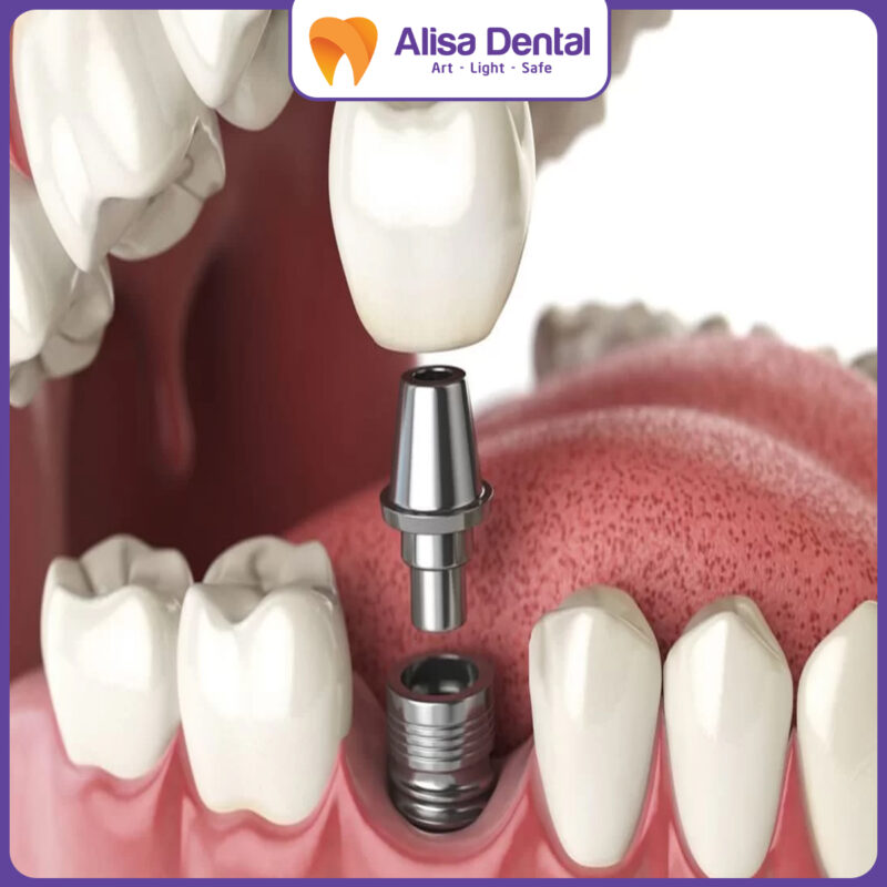 Trồng răng Implant 