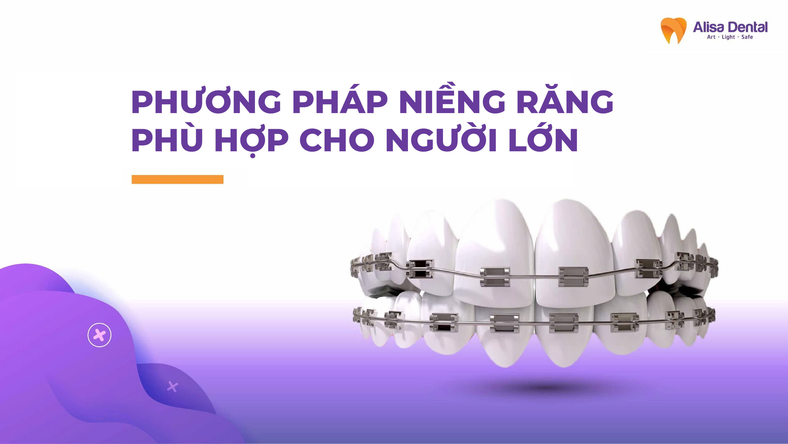 Phương pháp niềng răng phù hợp cho người lớn