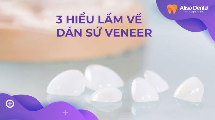 3 hiểu lầm về dán sứ veneer