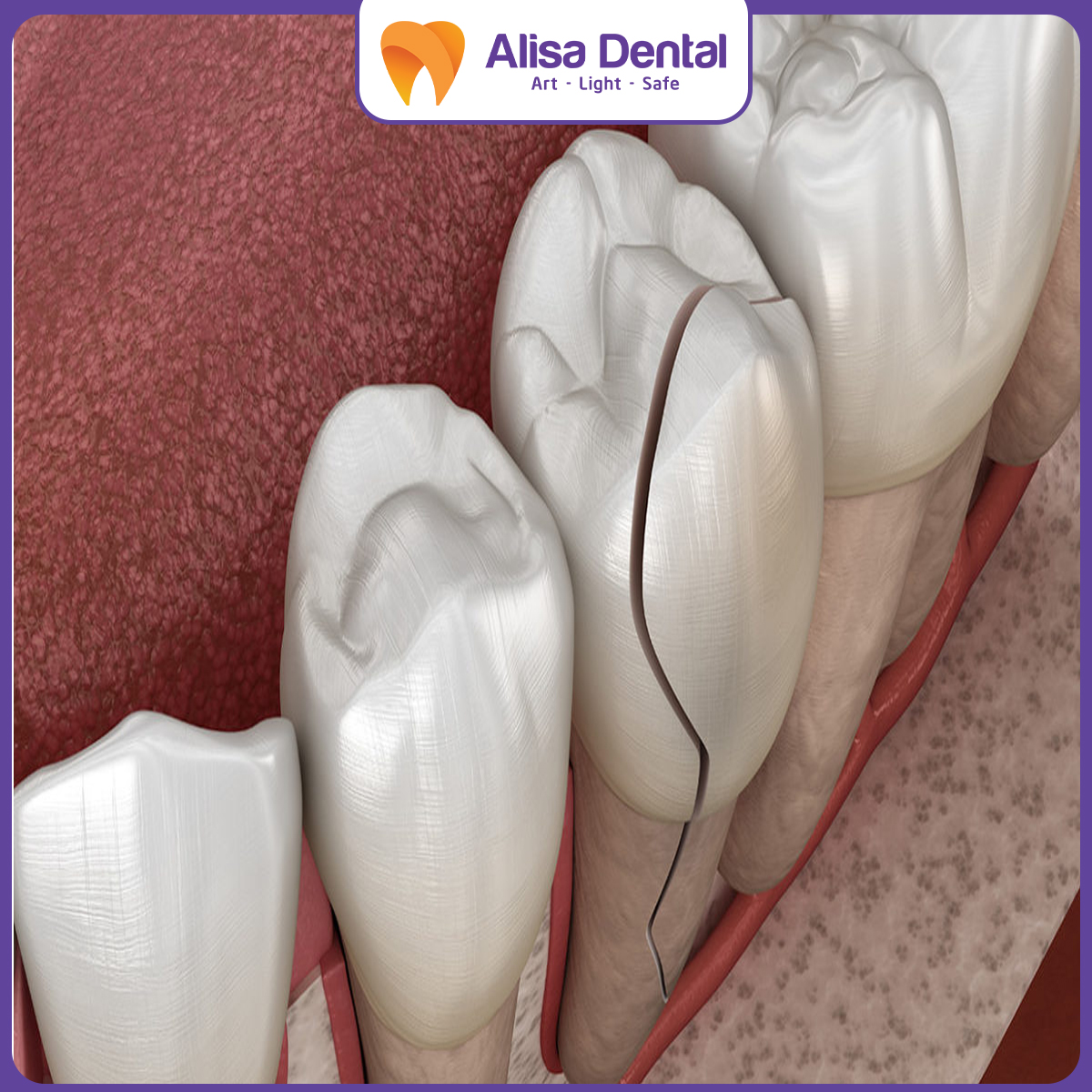 Răng bị nứt vỡ