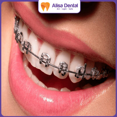 mắc cài trong niềng răng