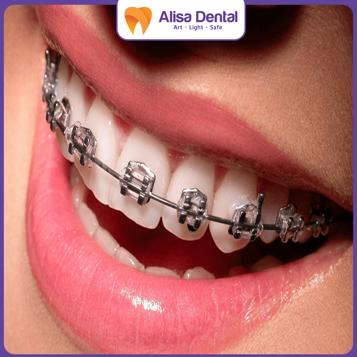 mắc cài trong niềng răng