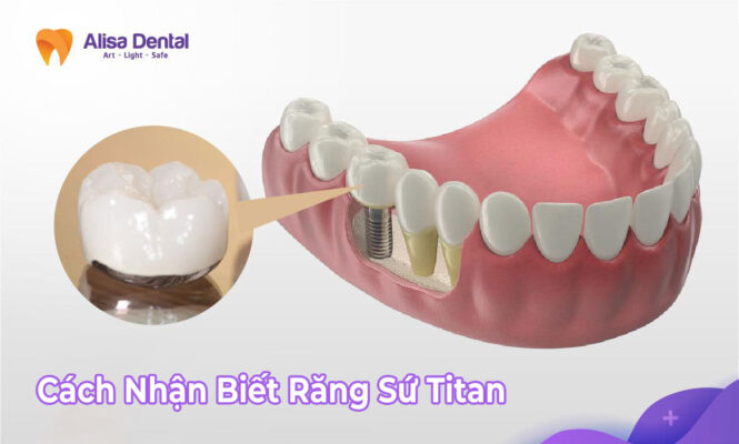 cách nhận biết răng sứ titan