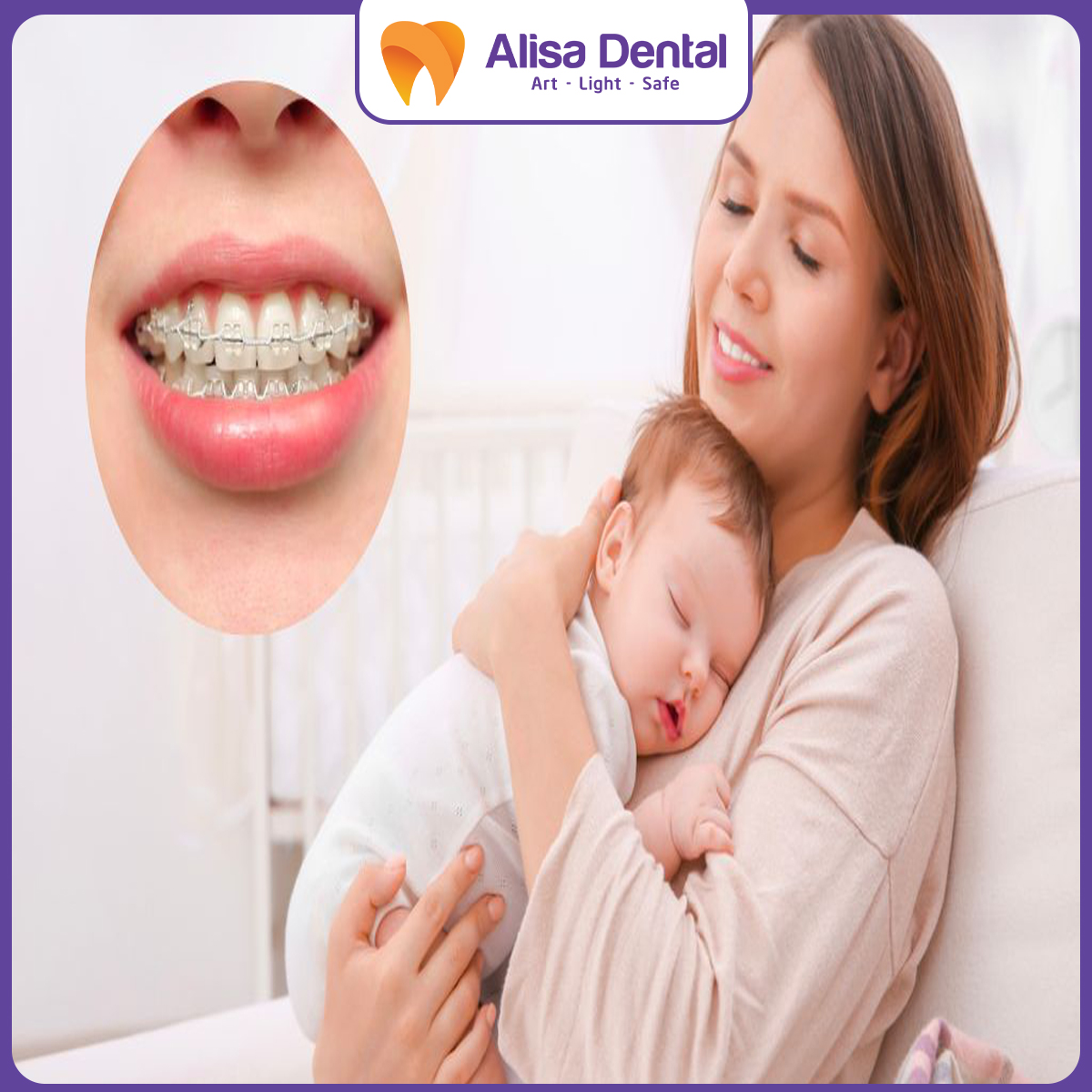 Niềng răng sau sinh