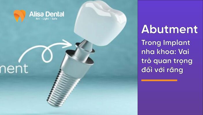 Abutment Implant Nha Khoa: Vai Trò Quan Trọng Đối Với Thành Công Của Phục Hình Răng