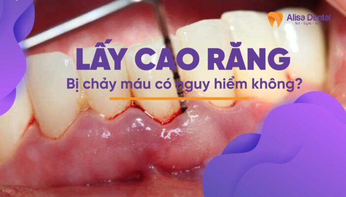 Lấy cao răng bị chảy máu có nguy hiểm không?