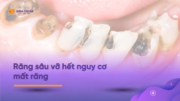 răng sâu bị vỡ hết