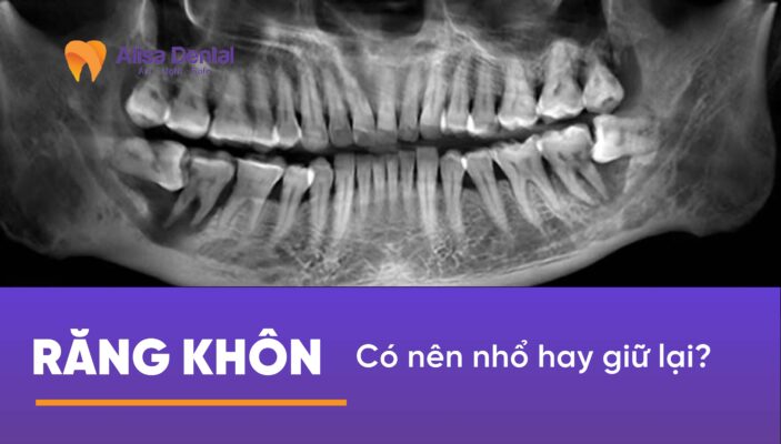 Răng khôn: Có nên nhổ hay giữ lại?