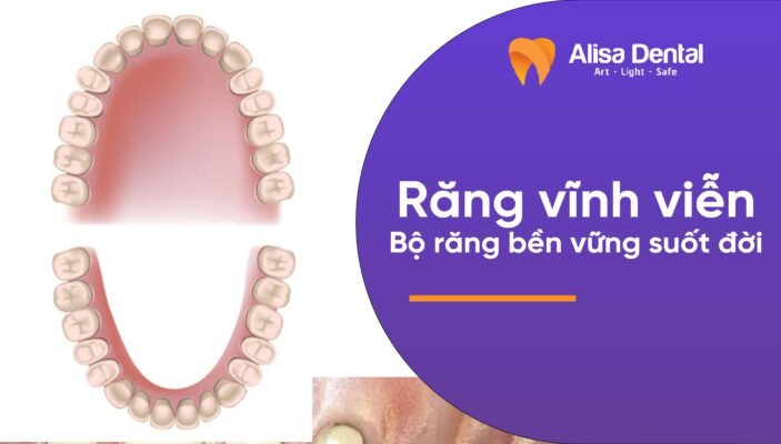 Răng vĩnh viễn: Bộ răng bền vững suốt đời