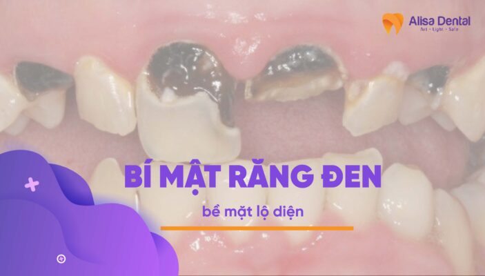 Bí mật răng đen bề mặt lộ diện