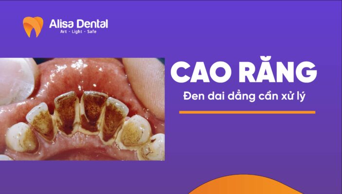 HIỂU RÕ VỀ CAO RĂNG ĐEN VÀ TẠI SAO NÓ TRỞ THÀNH VẤN ĐỀ DAI DẲNG