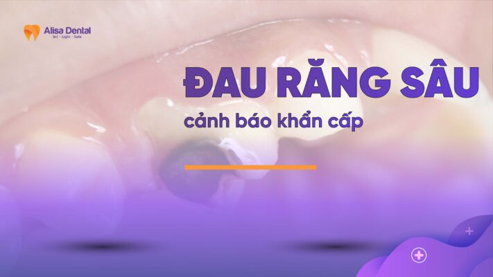 Đau răng sâu cảnh báo khẩn cấp