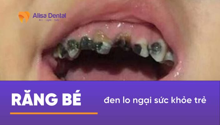 Răng bé đen lo ngại sức khỏe trẻ