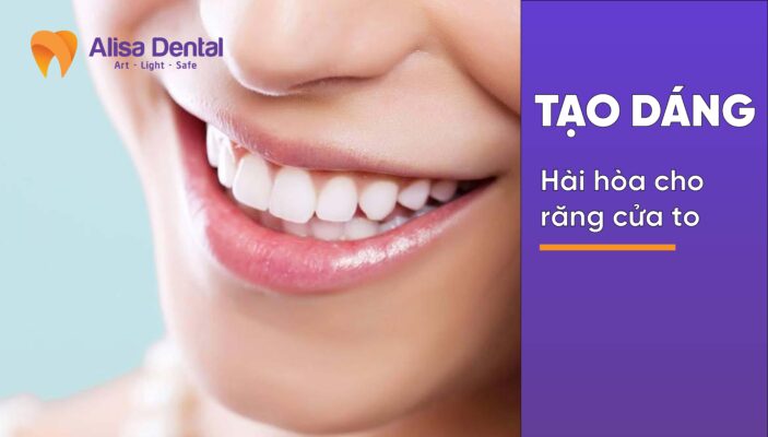 Tạo dáng hài hòa cho răng cửa to