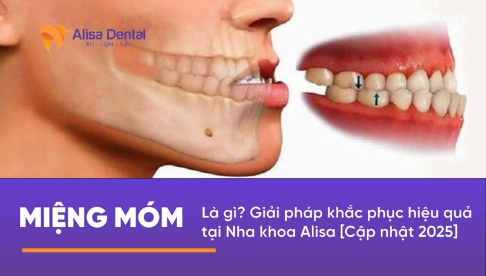 Khắc phục miệng móm lấy lại sự cân đối