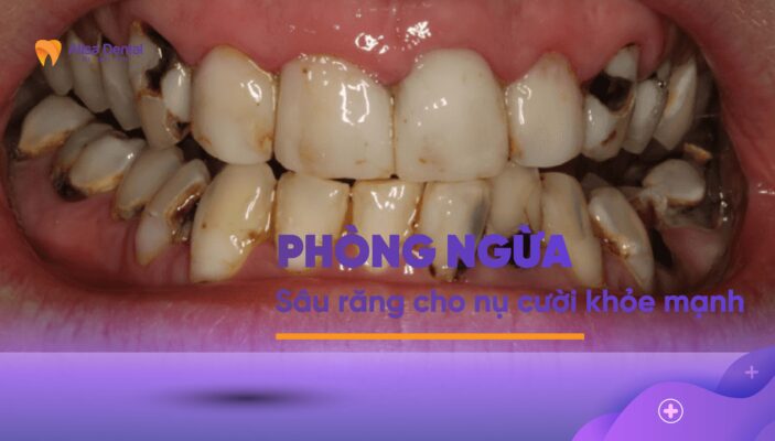 Phòng ngừa sâu răng cho nụ cười khỏe mạnh