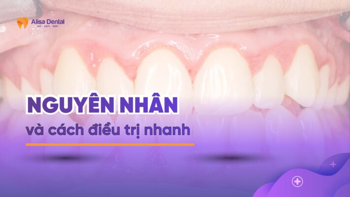 Nguyên nhân và cách điều trị nhanh viêm nướu răng