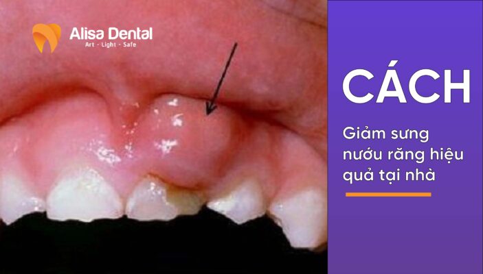 Cách giảm sưng nướu răng hiệu quả tại nhà
