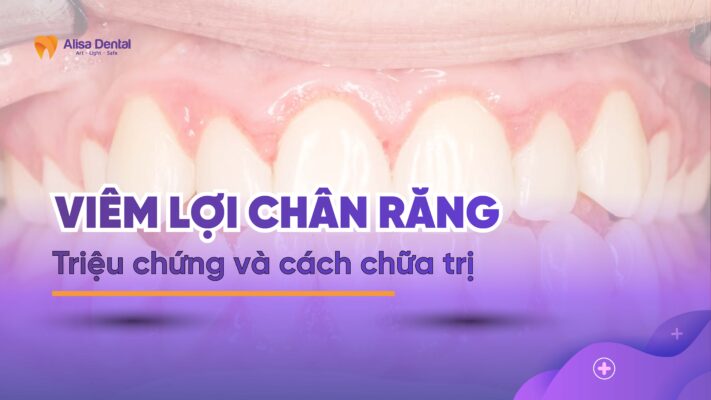 Viêm lợi chân răng: Triệu chứng và cách chữa trị