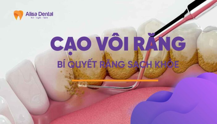 Cạo Vôi Răng: Bí Quyết Răng Sạch Khỏe