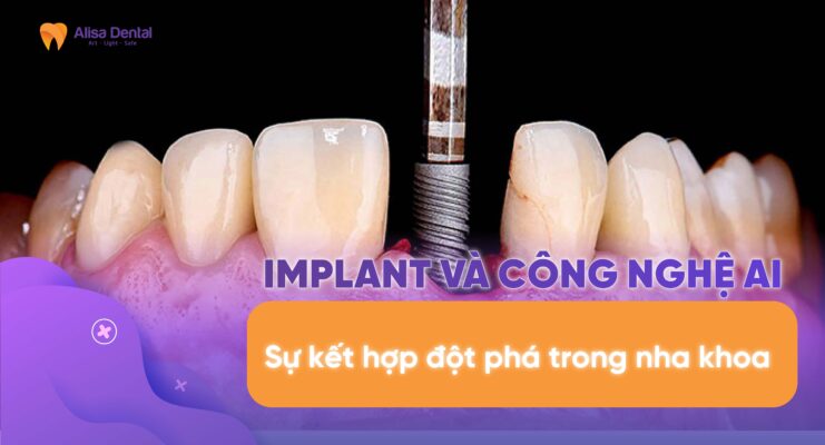 Implant và công nghệ AI: Sự kết hợp đột phá trong nha khoa