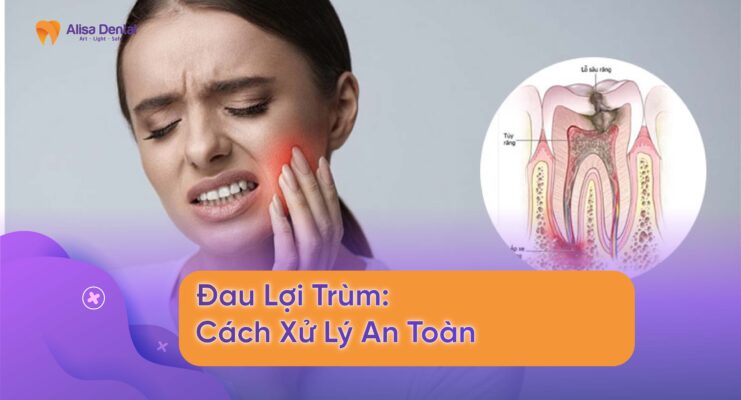 Đau Lợi Trùm: Cách Xử Lý An Toàn